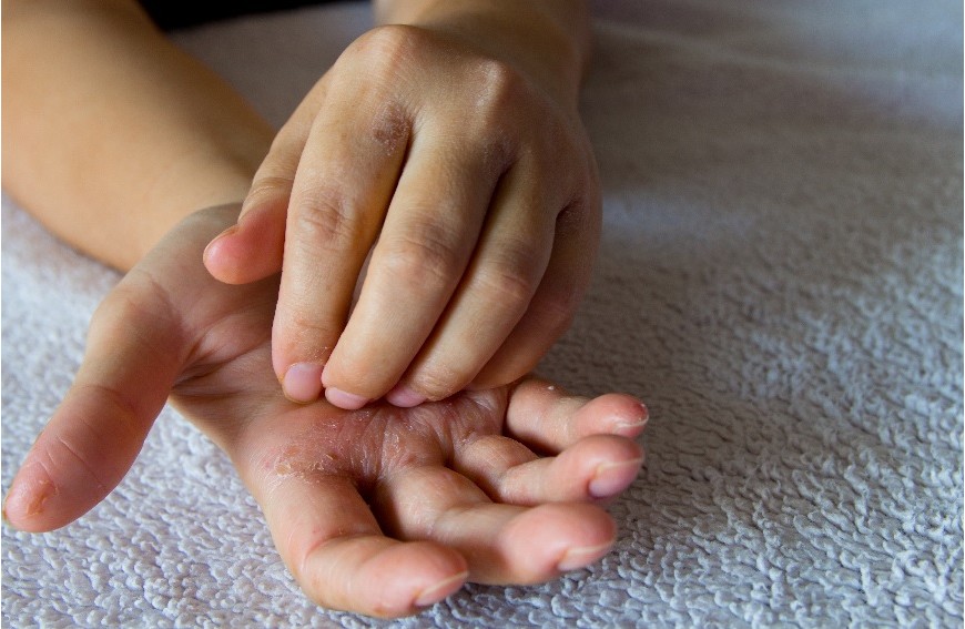 Łuszczyca – to nie tylko choroba skóry